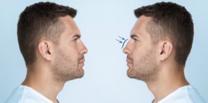 rinoplastica maschile prima e dopo Padova risultato naturale naso uomo