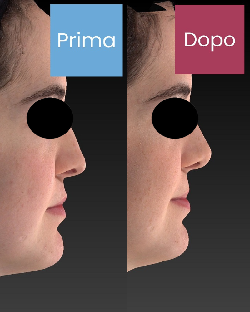 rinoplastica estetica paziente 3